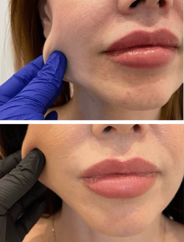 Injectare Sculptra 3 Comparatie inainte si dupa injectarea cu Sculptra pentru redarea volumului facial