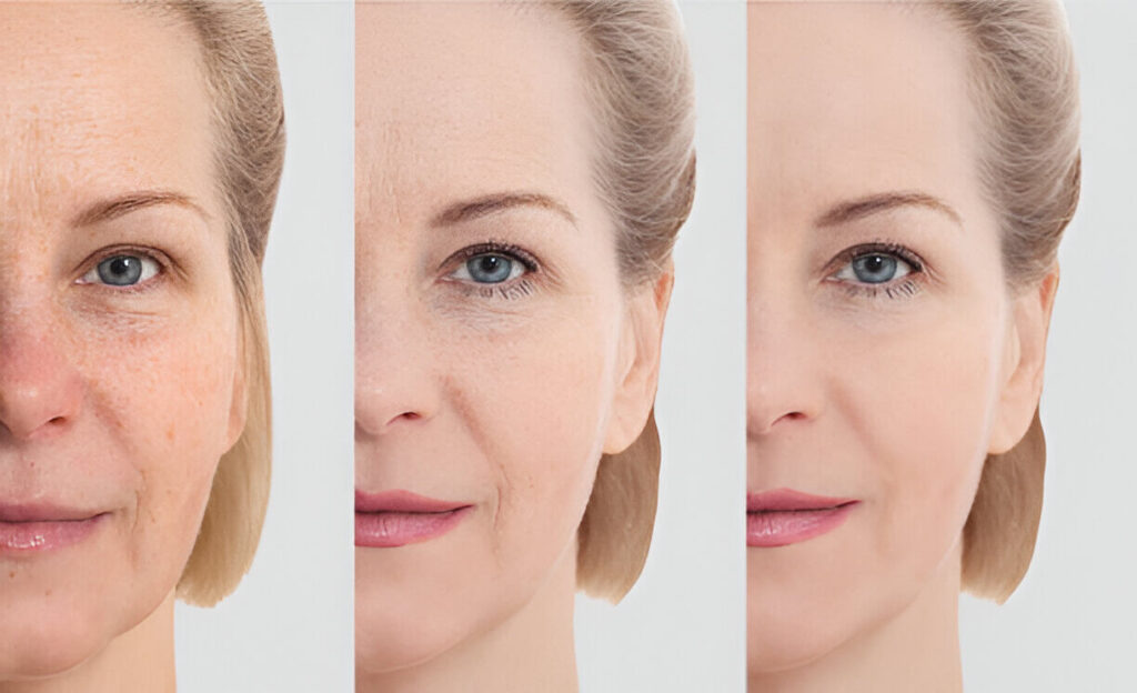 Injectare Sculptra 2 rezultate progresive colagen